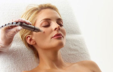 Microdermabrasion